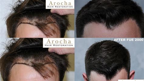 Dr Arocha 2000 Graft FUE Result Hair Transplant Mentor