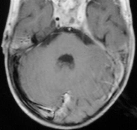 Imaging Of Complications Of Acute Mastoiditis In Children Radiographics