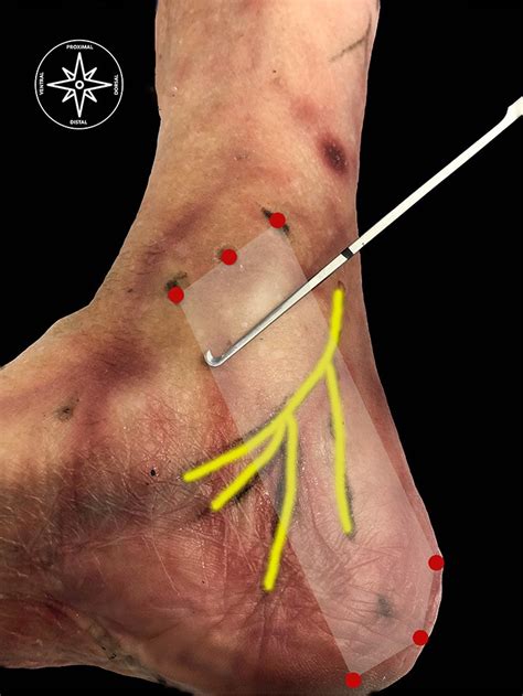 Ultrasound Guided Decompression Surgery Of The Tarsal Tunnel A Novel Technique For The Proximal