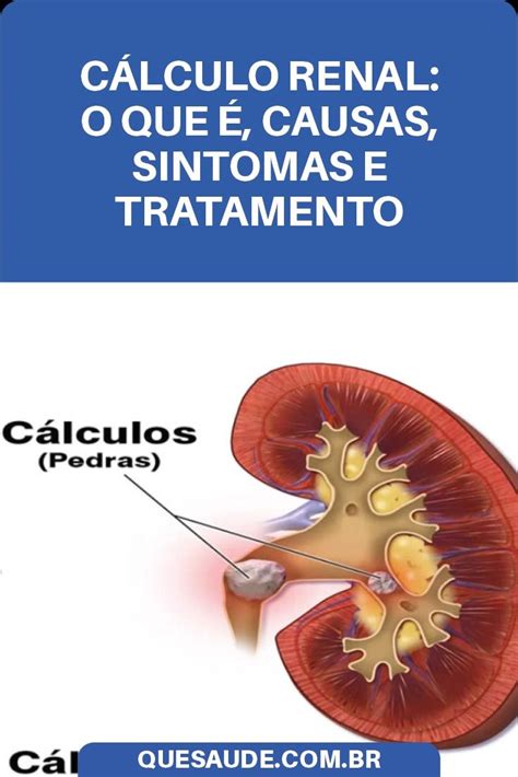 Cálculo Renal O Que é Causas Sintomas e Tratamento Cálculo renal