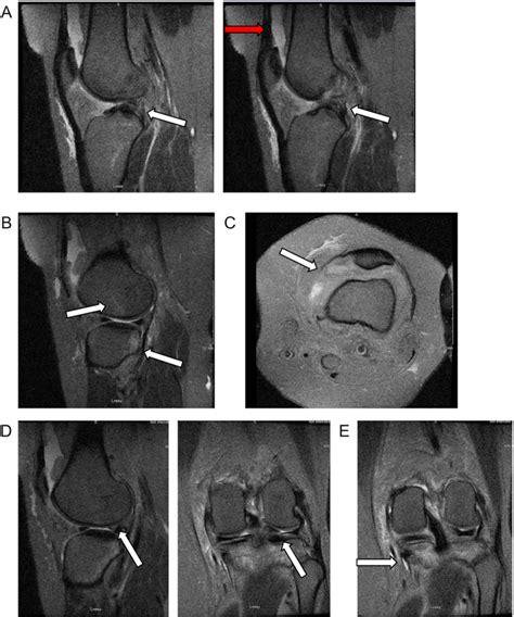 Sagittal Cuts Of Magnetic Resonance Imaging Mri Of The Left Knee