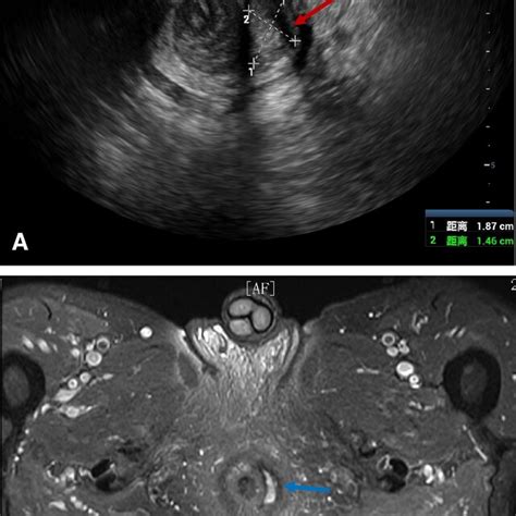 Anal Fistula Type II In Pelvic 3D US And MRI Images A Pelvic 3D US