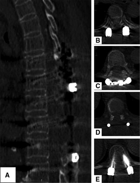 Frontiers Multiple Ossified Spinal Meningiomas In The Thoracic Spine