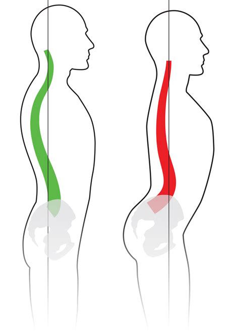 Colonne vertébrale Lordose Hyperlordose Hypolordose Sténose