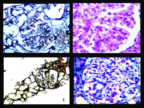 Morphological Spectrum Of Various Crescentic Glomerulonephritis Figure