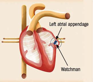 A device to prevent strokes in afib - Harvard Health