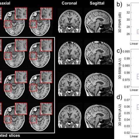 Gray Matter GM White Matter WM And Cerebrospinal Fluid CSF