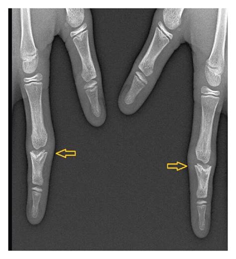 A Cone Shaped Epiphyses Of The Middle Phalanges Of The Second Digit