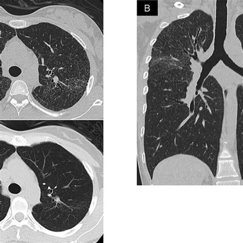 Chest High‐resolution Computed Tomography Hrct Revealed Miliary Download Scientific Diagram