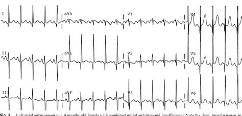 Figure 5 From The Pediatric Electrocardiogram Part I Age Related