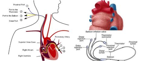 Pulmonary Capillary Wedge Pressure: What is it? How doctors measure it ...