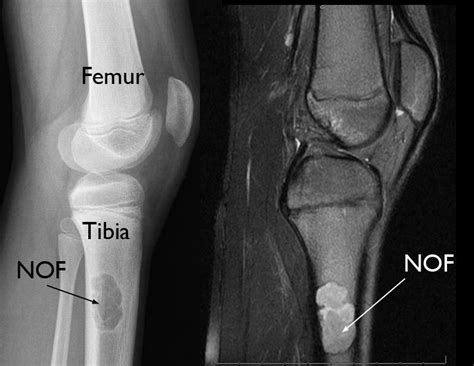 Nonossifying Fibroma Orthoinfo Aaos