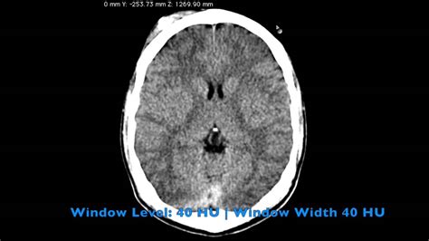 How To Read Ct Scan Head