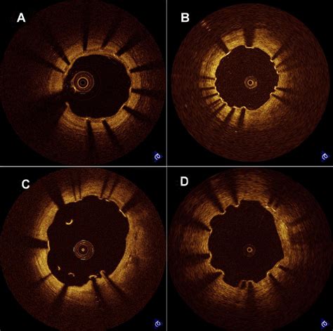 Intracoronary Optical Diagnostics Current Status Limitations And