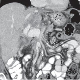 Computed Tomography Scan After Three Months Post Total Pancreatectomy