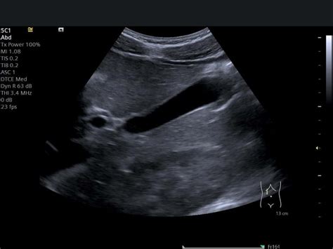 Private Abdominal Ultrasound Scan Abdominal Ultrasound London