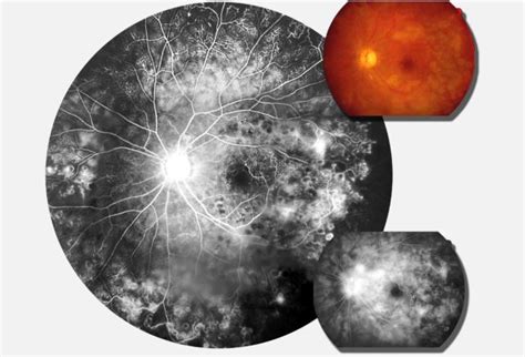 Swept Source Oct A Shows Structural Changes In Retinal Vasculitis