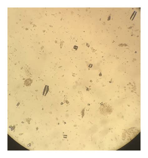 Urine Microscopy Under Low Power Magnification Showing Uric Acid