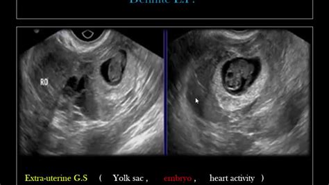 Ectopic Pregnancy Ultrasound 8 Weeks