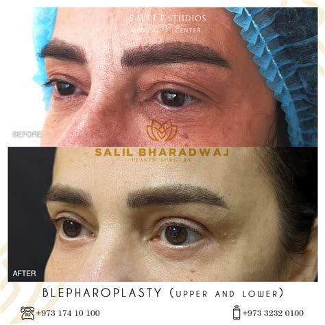 Blepharoplasty Gallery - Smile Studios - Best Medical Center in Bahrain ...