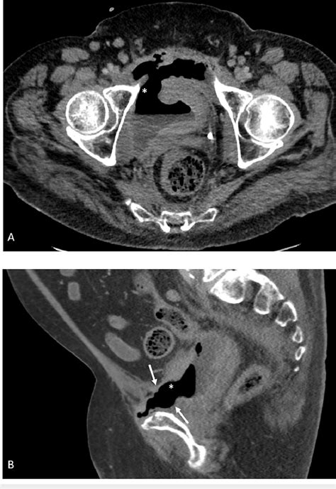 Contrast Enhanced Ct Images Through The Pelvis In Axial A And