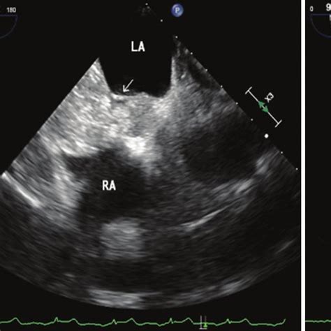 A Transthoracic Echocardiography Apical Four Chamber View Showing A