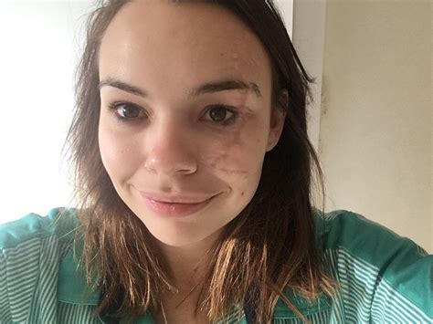Lupita Scar On Face 💖 Similar To 33829972 Popular Hd Royalty Erofound