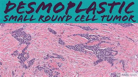 Desmoplastic Small Round Cell Tumor Minute Pathology Pearls Youtube