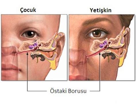 Burun ve Kulak Tıkanıklığı Belirtileri ve Tedavisi