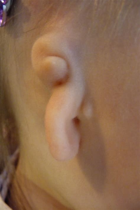 Microtia Atresia Ear Community