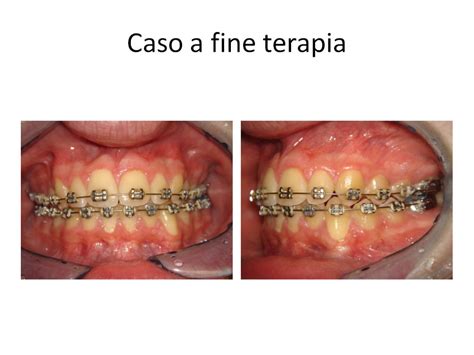 Canino Incluso Inferiore Dentista Roma