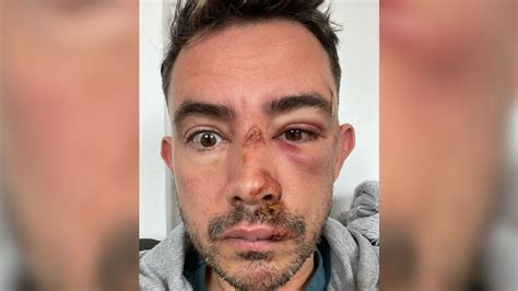 J’ai été Victime D’une Agression Homophobe à Lyon Deux Hommes Portent Plainte Après Avoir