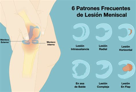 Lesión de Meniscos Síntomas causas y tratamientos Forza Kinesiologia