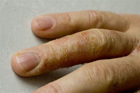 Seborrheic Dermatitis On Fingers Atopic Dermatitis Symptoms Images