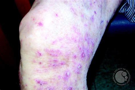 Leukemia Cutis 1