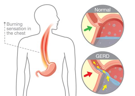 Stretta Treatment Dubai Gastroenterology Clinic