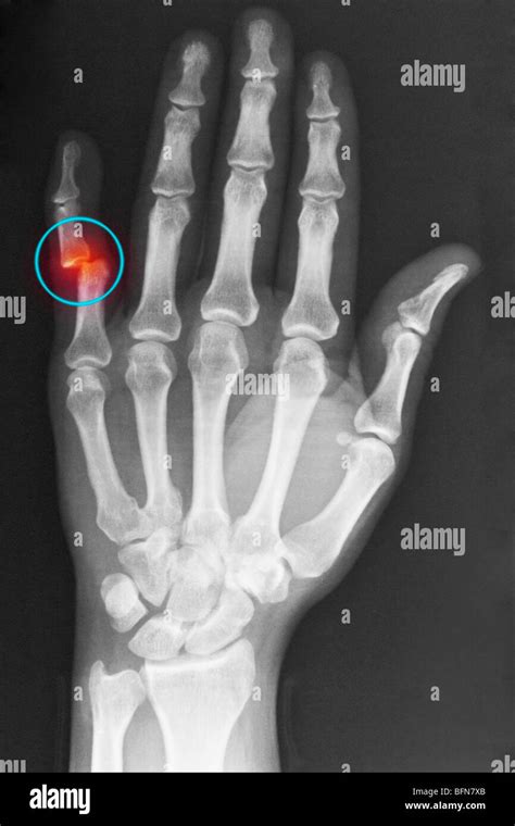 Distal Interphalangeal Joint