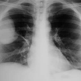 Chest X Ray A Posterior Anterior View Of Chest X Ray Showing Almost