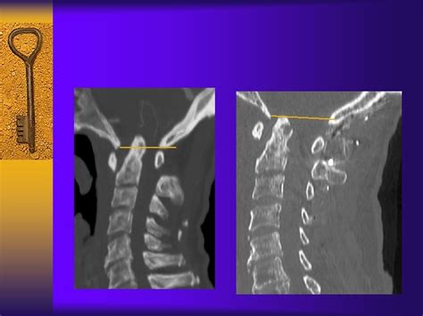 Cervical Spine Surgery For Patients With Rheumatoid Arthritis