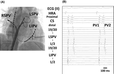 A An Electrode Position During Electrophysiological Study And AF