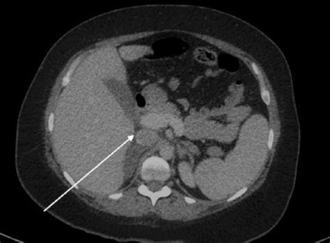 Unilateral Adrenal Infarction In Pregnancy Secondary To Elevated Factor