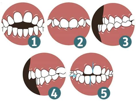 Brackets over 40 es útil la ortodoncia en adultos SwissDent