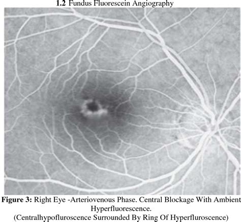 Figure 3 From A Case Report Of Adult Vitelliform Macular Dystrophy Semantic Scholar