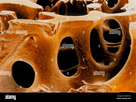 Human Bone Coloured Scanning Electron Micrograph Of Trabeculae In