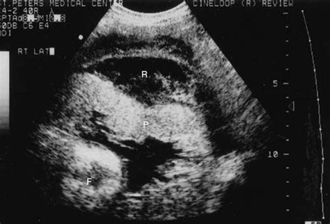 Us Placenta Placental Abruption Large Retroplacental Sonographic