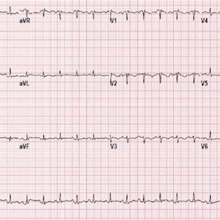 Electrocardiogram Of The Patient Showing Sinus Tachycardia With T Wave