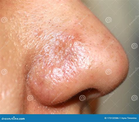 Inflamed Pimple On Nose Cyst Acne Stock Photo Image Of Clogged