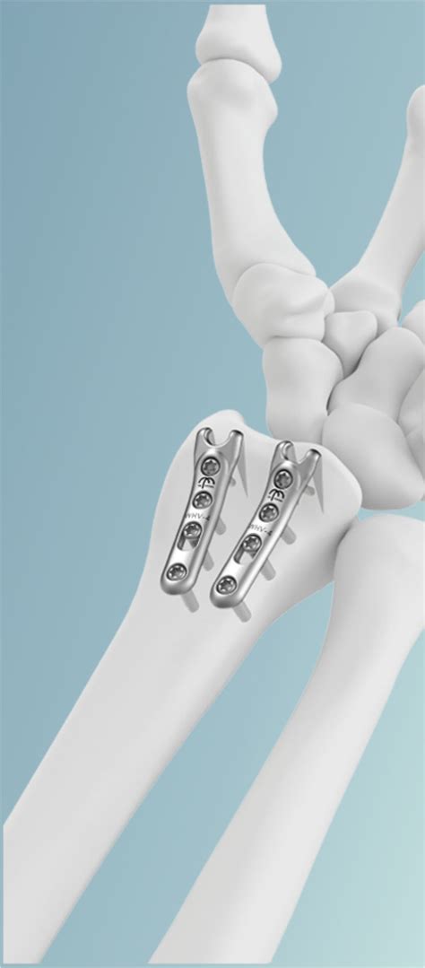 Upper And Lower Extremity Orthopedic Implants Trimed