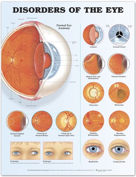 Disorders Of The Eye Infographic Best Infographics