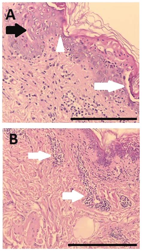 A And B Hematoxylin And Eosin Staining Magnification X400 Showing